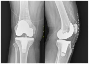 An Xray of knees. Knee replacement defects and recalls. Zimmer NexGen Defects.