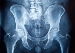 An Xray of hips. Stryker Hip Implant recalls. Defective medical devices.