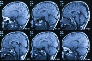Brain scans. Traumatic Brain Injuries (TBI) Recognizing Symptoms & Preventing Deaths & Disabilities