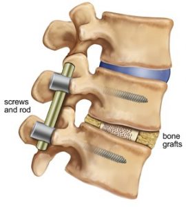 Graphic of a lumbar surgery showing screws and rods and bone grafts.