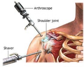 Surgery on the sholder showing joint, arthroscope and shaver