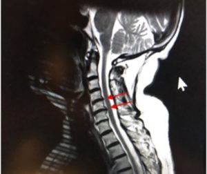 Black and white x-ray of the neck and spinal cord with red arrows pointing to problem area.