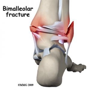 A medical depiction of a Bimalleolar Fracture