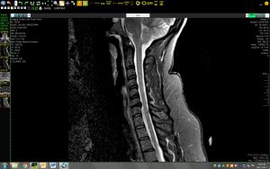 X-ray showning herniation of the neck