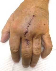 Ligament Repair Surgery of Hand with stitches