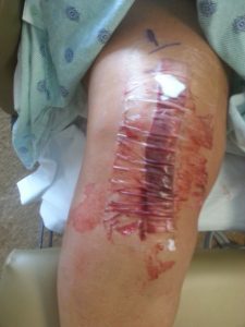 Knee surgery photo