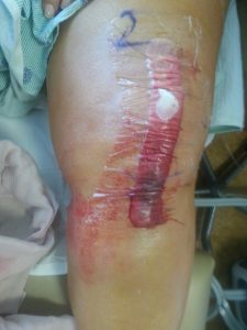 Visual of knee post surgery 
