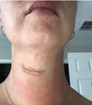 Photo of women's neck post neck surgery