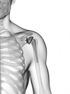 3d rendered illustration of a shoulder replacement