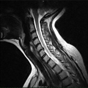 MRI showing herniation of the neck at C5-6
