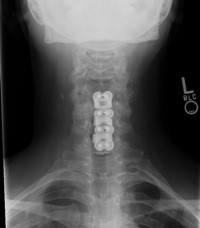 x-ray showing the three-level ACDF