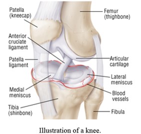 Knee illustration showing meniscal tear