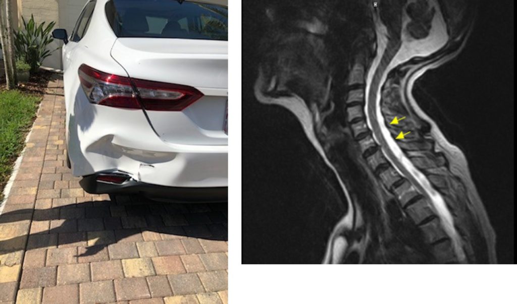 White car with rear-end damage due to accident and X-ray showing neck injuries