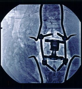 X-ray of back showing insertion of a titanium spacer