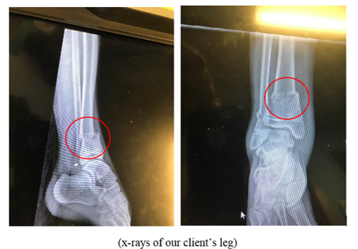 Xrays showing broken ankle in two places