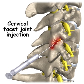 Skeleton showing Cervical Facet Joint Injection being adminstered