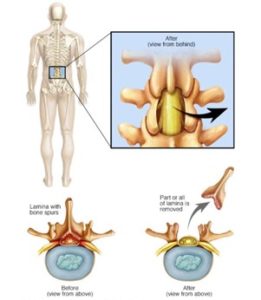 Low back surgery illustration- laminectomy