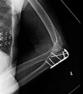 Post surgery elbow showing fracture repair