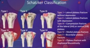 A graphic showing the six Schatzker Classification of Tibial Plateau Fractures.