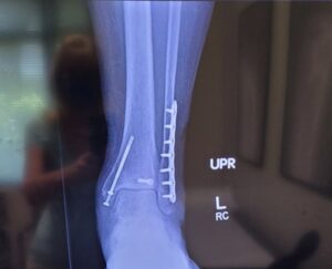 X-ray of a client’s left ankle following a trip and fall