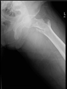 X-ray showing a severe left femoral neck fracture