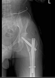 X-ray showing a severe left femoral hip fracture