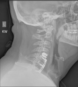 Xray showing disc replacement / fusion surgery to a person's cervical spine