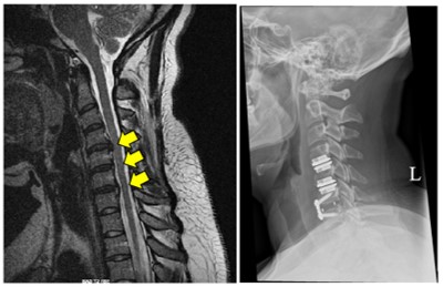 Post-surgical x-rays showing the three herniations and permanent, post-surgical hardware in our client’s cervical spine.