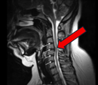 Xray of a herniated Disc