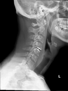 X-Ray, Side view of neck injury