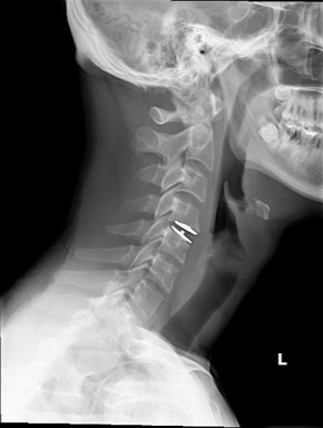 X-Ray, Side view of neck injury