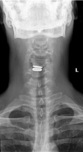 X-Ray - viewing from back of neck, showing injury